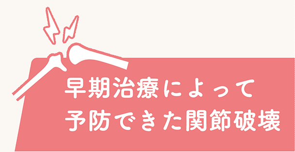早期治療によって予防できた関節破壊